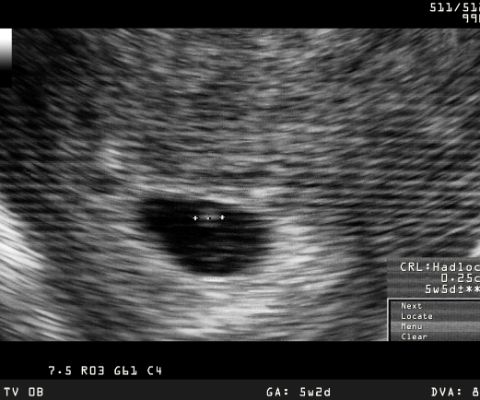 Échographie d’un bébé à la 3e semaine de grossesse